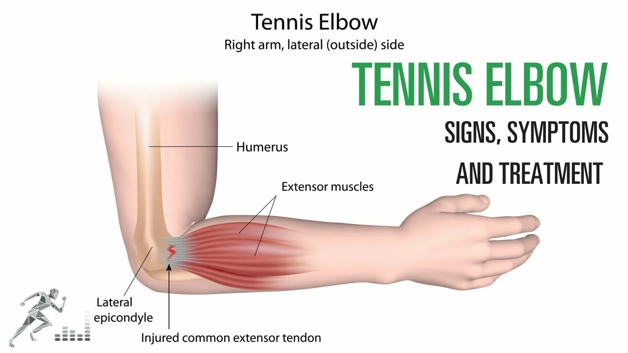 Is R.I.C.E. the right treatment approach to Tennis Elbow?
